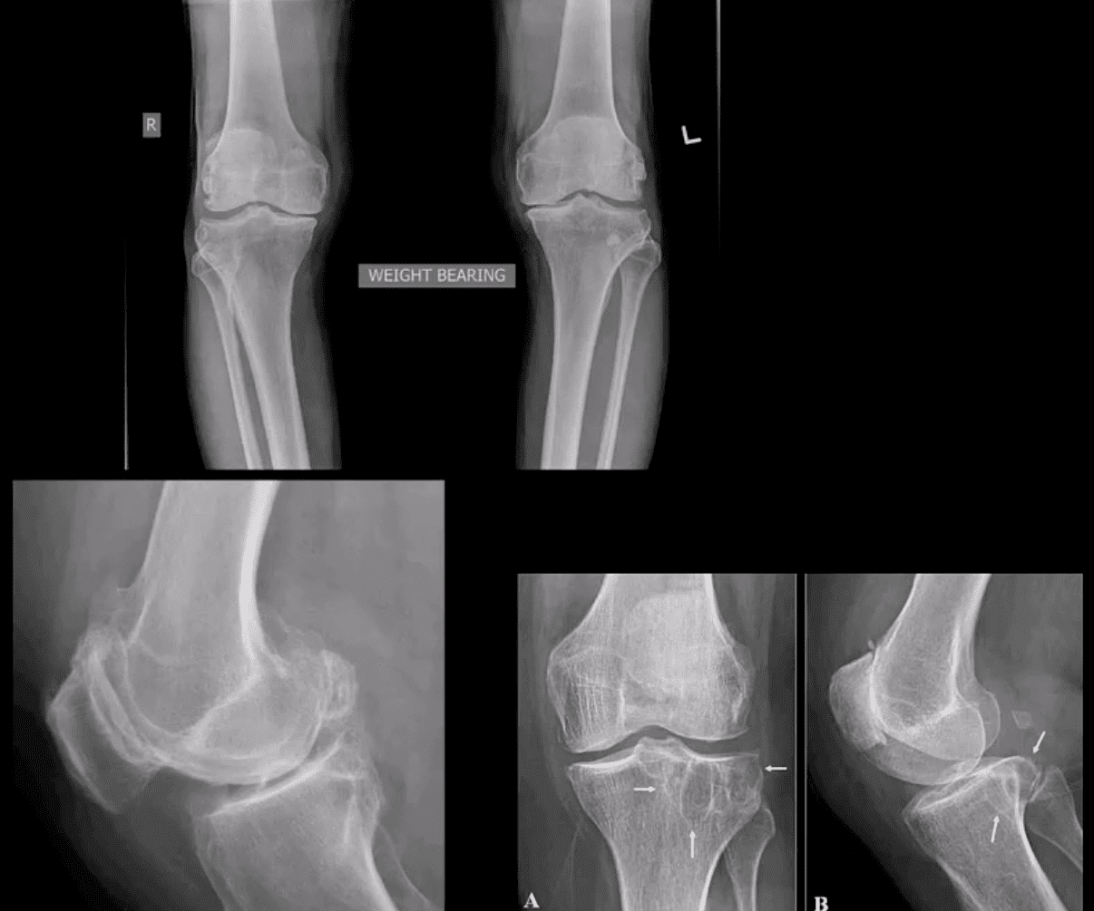 arthrite du genou soins chiropratiques el paso tx.