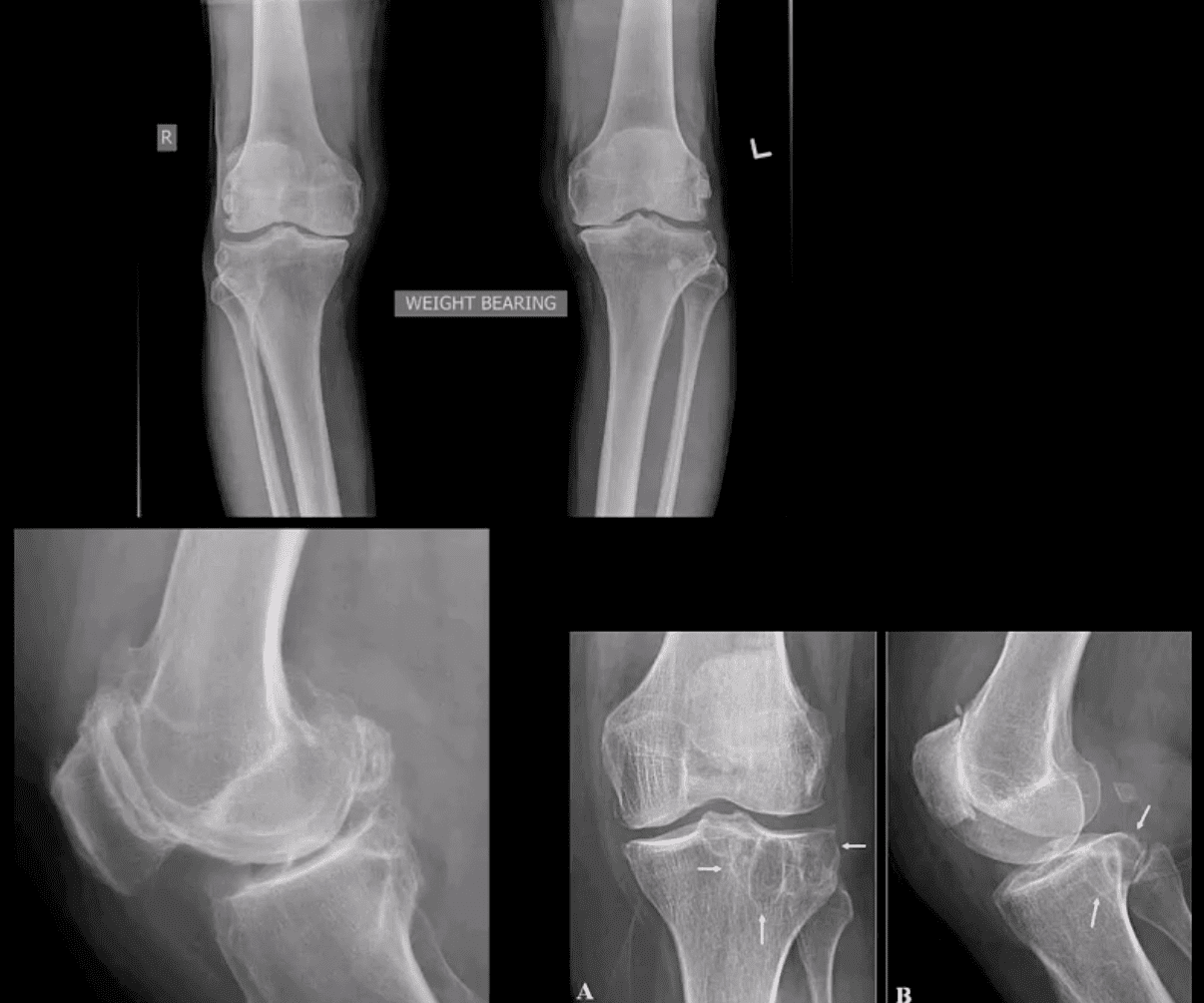 Artritis de rodilla atención quiropráctica el paso tx.