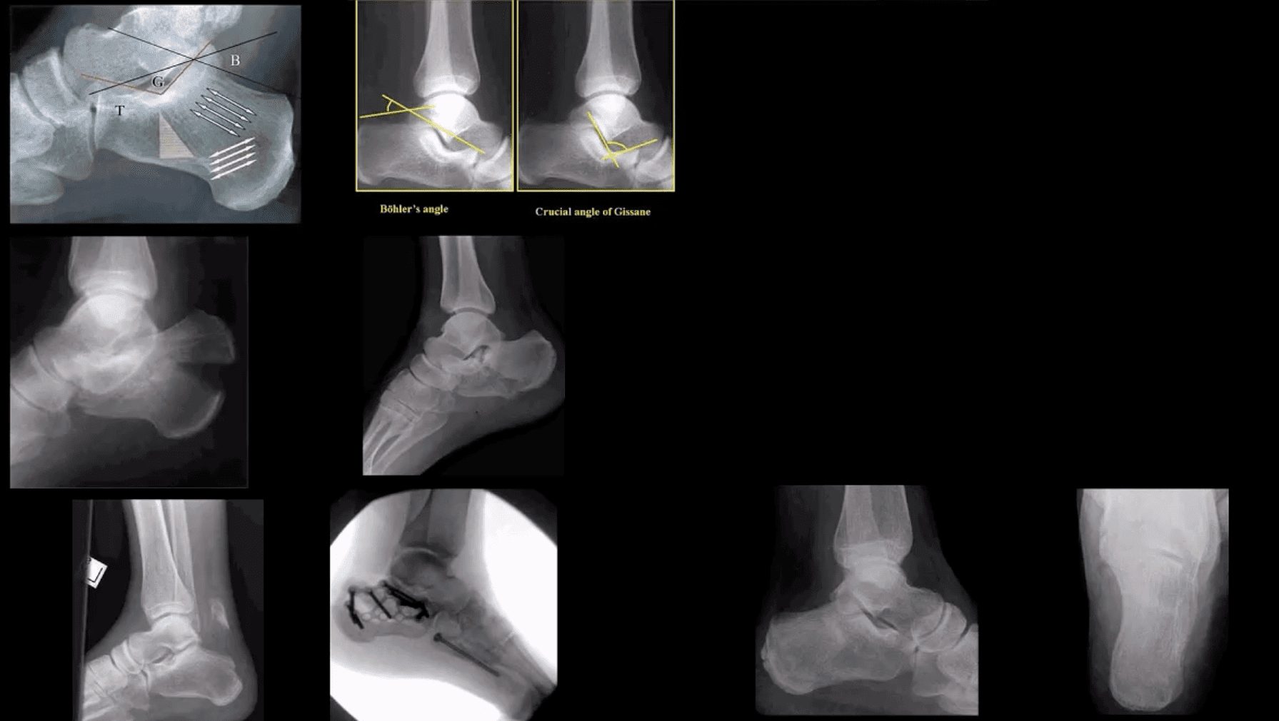 ankle foot arthritis and trauma el paso tx.