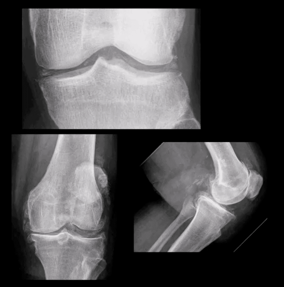 Artritis de rodilla atención quiropráctica el paso tx.