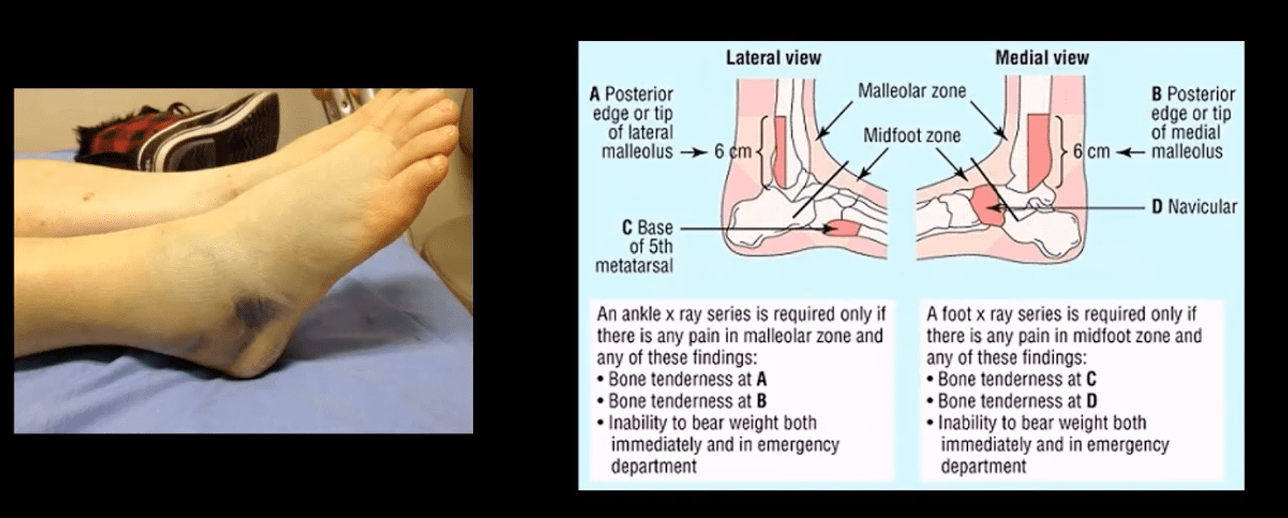 ankle foot arthritis and trauma el paso tx.