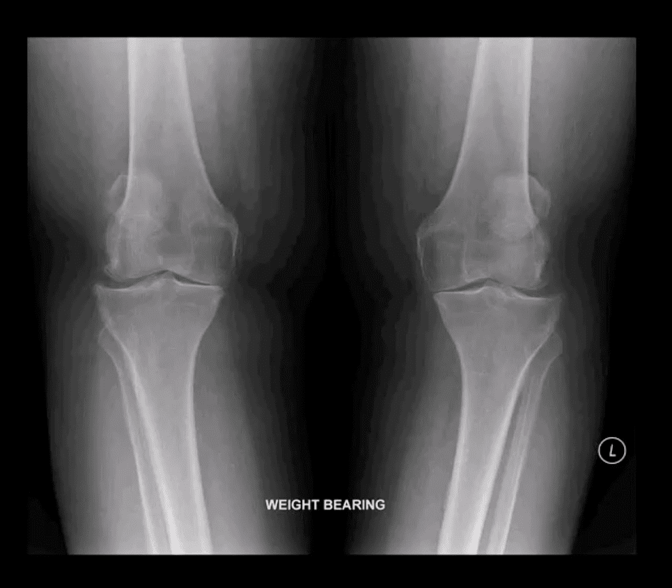 Artritis de rodilla atención quiropráctica el paso tx.