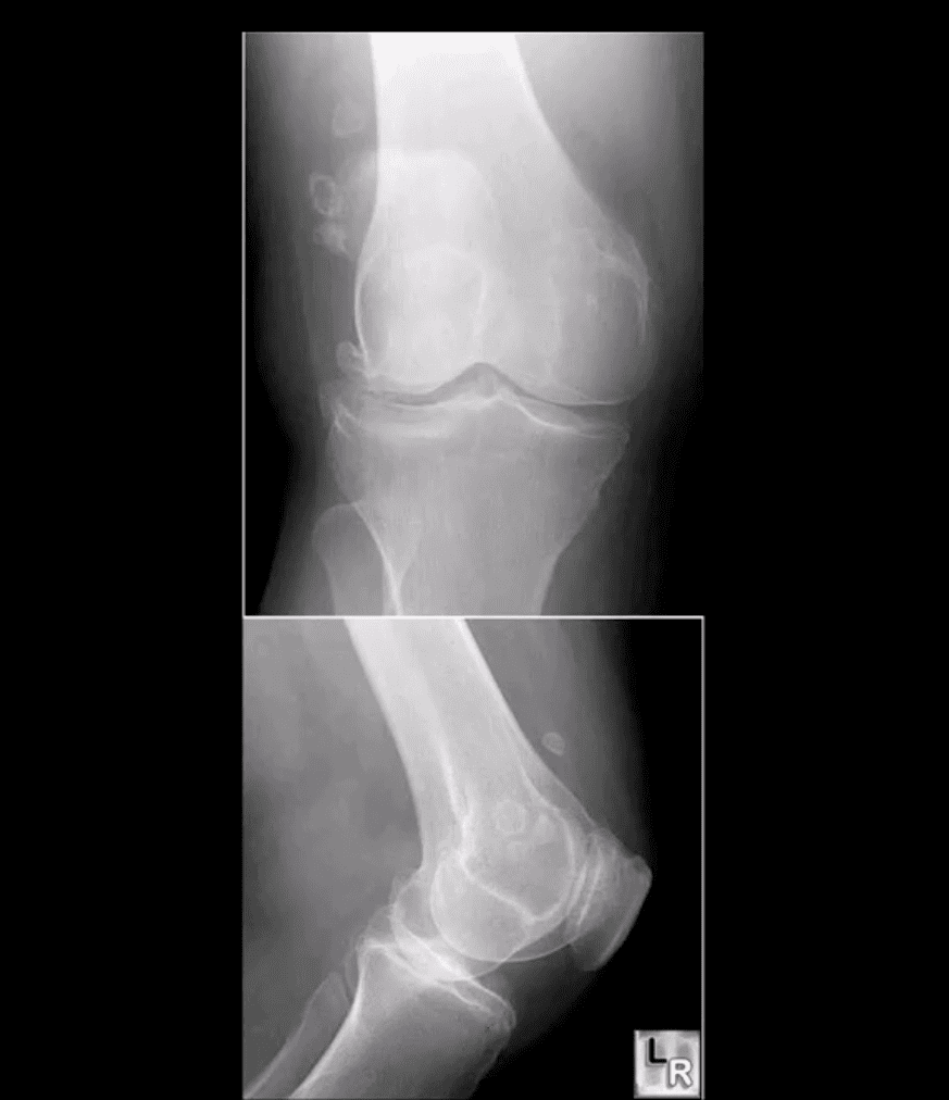 knee arthritis chiropractic care el paso tx.