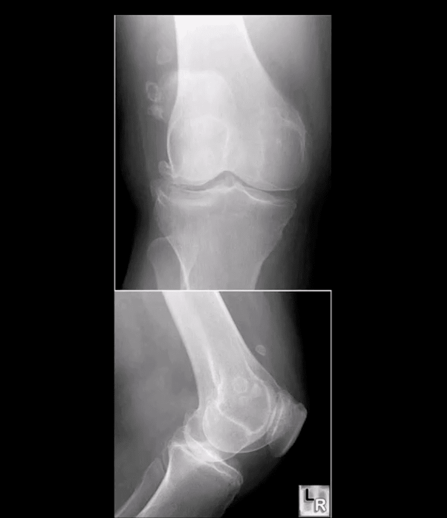 Artritis de rodilla atención quiropráctica el paso tx.