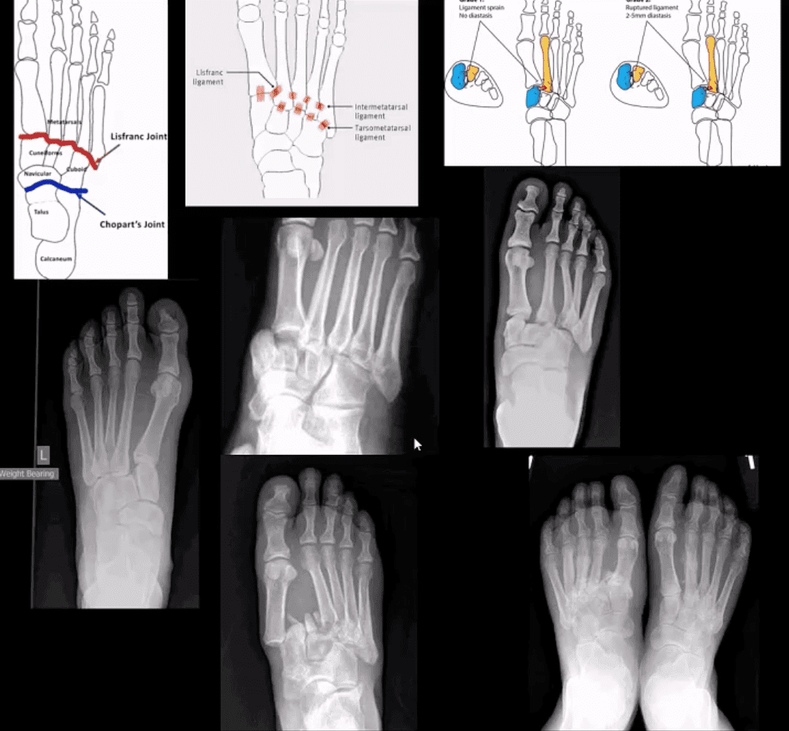 ankle foot arthritis dan trauma el paso tx.