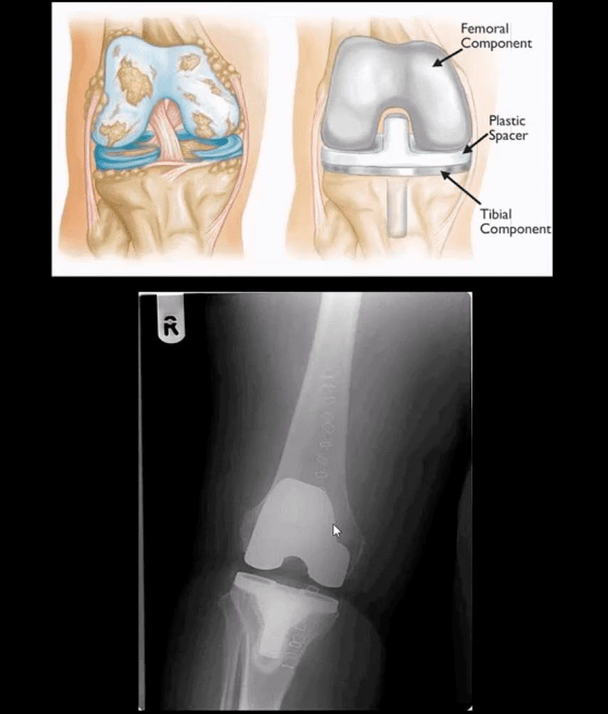 Artritis de rodilla atención quiropráctica el paso tx.