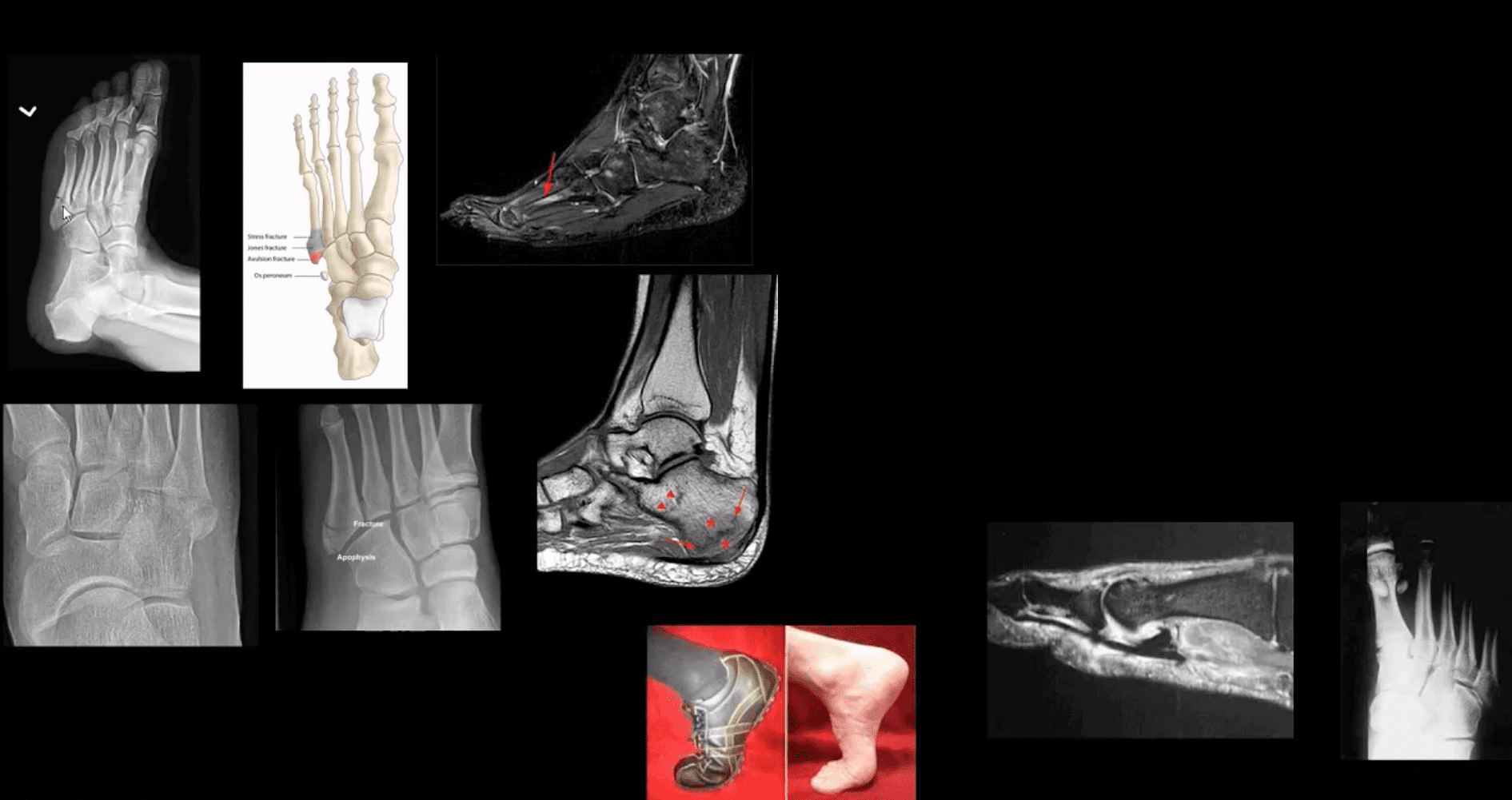 ankle foot arthritis and trauma el paso tx.