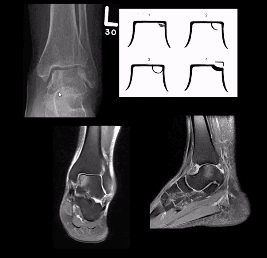 ankle foot arthritis dan trauma el paso tx.