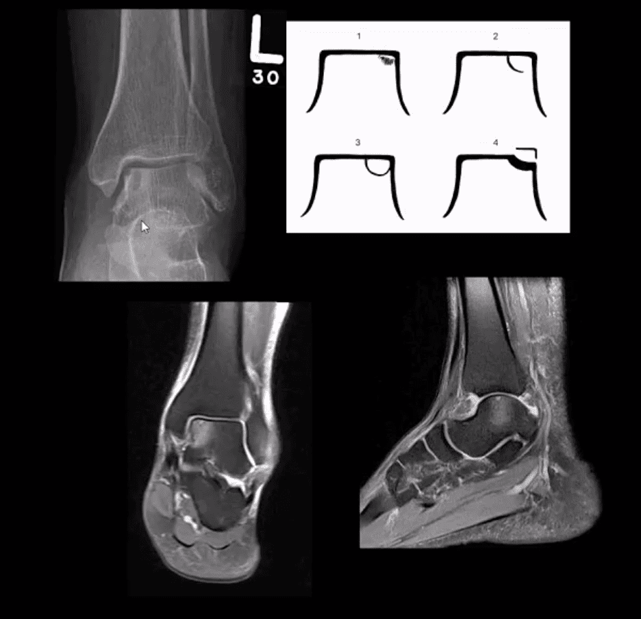 ankle foot arthritis and trauma el paso tx.