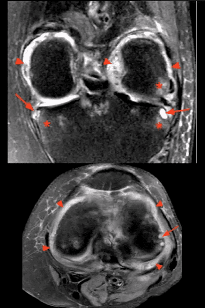 Artritis de rodilla atención quiropráctica el paso tx.