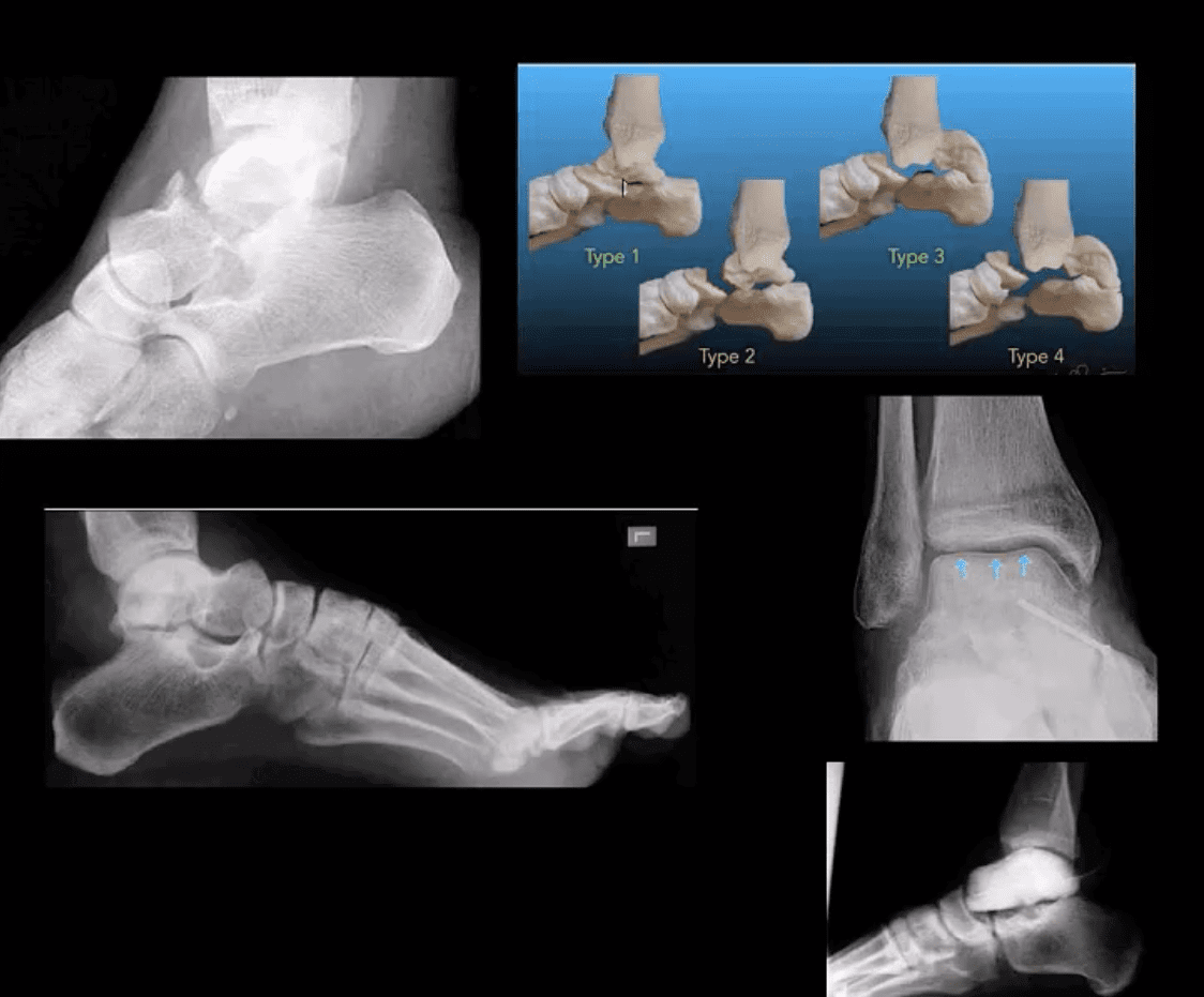 ankle foot arthritis and trauma el paso tx.