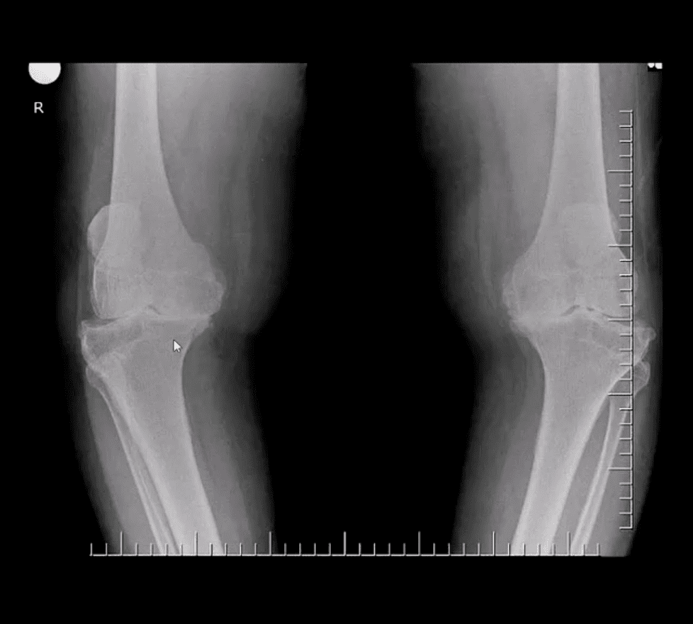 Artritis de rodilla atención quiropráctica el paso tx.