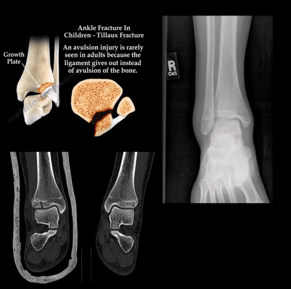 ankle foot arthritis and trauma el paso tx.