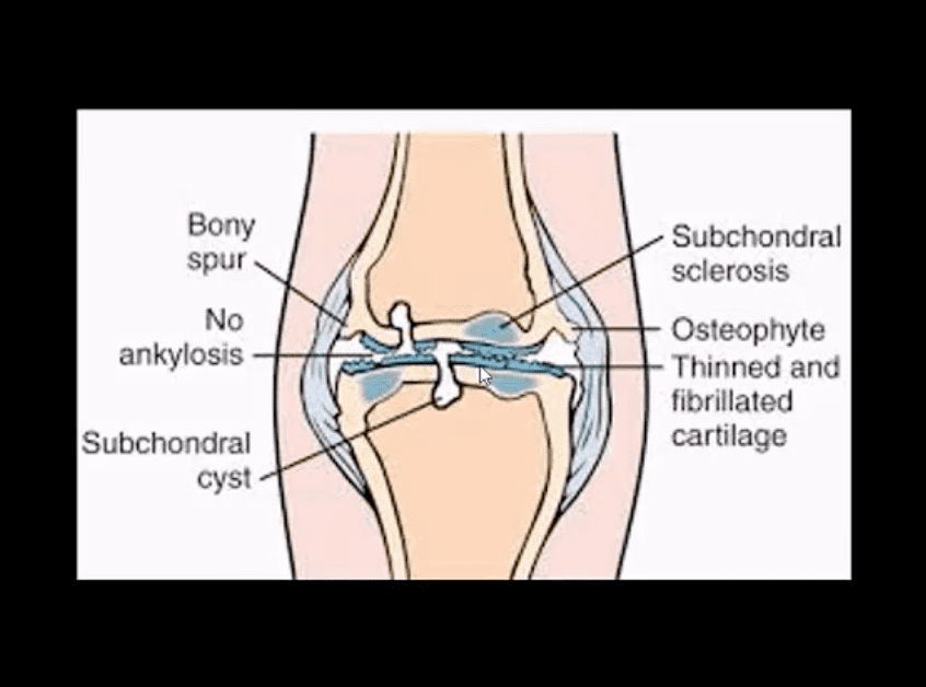 Artritis de rodilla atención quiropráctica el paso tx.