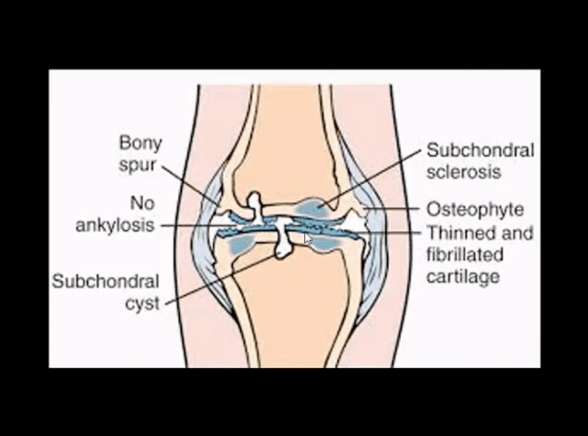 arthrite du genou soins chiropratiques el paso tx.