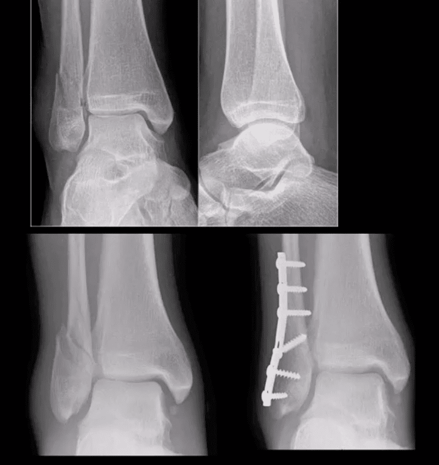 ankle foot arthritis and trauma el paso tx.