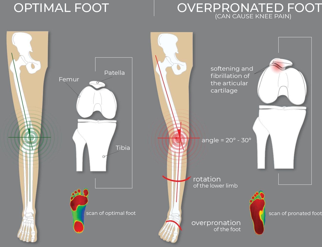 Embarking on the Journey to Correct Overpronation