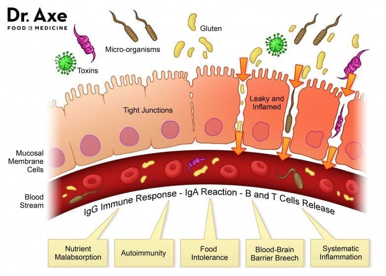 Intestino permeable.jpg