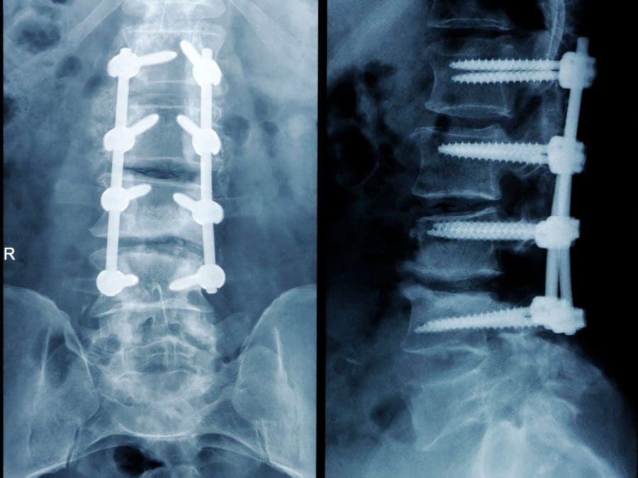 Pseudoarthrosis: Understanding Failed Spinal Fusion