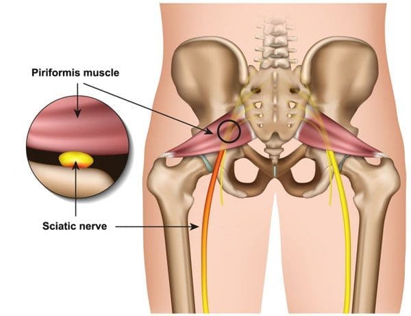Relieve Pain and Numbness: Managing Piriformis Syndrome