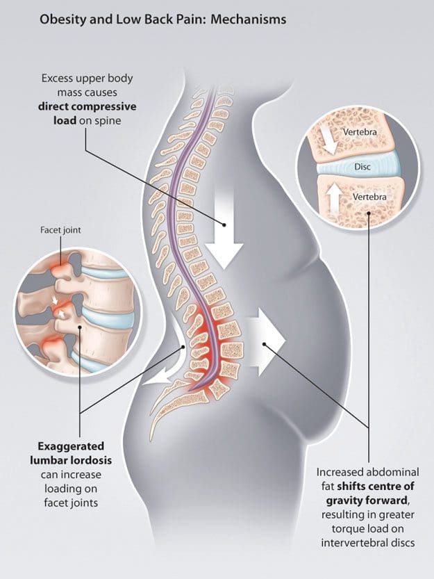 Losing Weight To Alleviate Back Pain