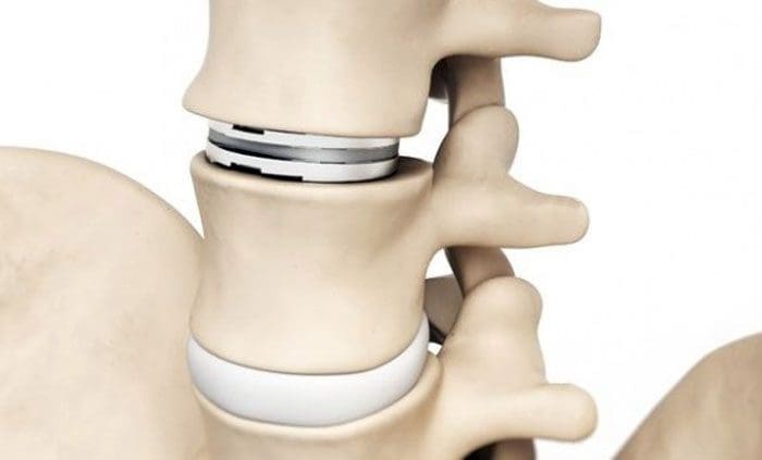 Lower/Lumbar Back Total Disc Replacement or Fusion Options
