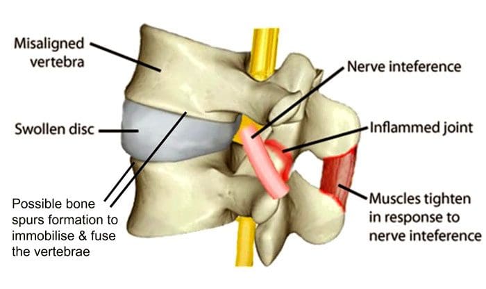 Spinal Misalignment Symptoms and Chiropractic