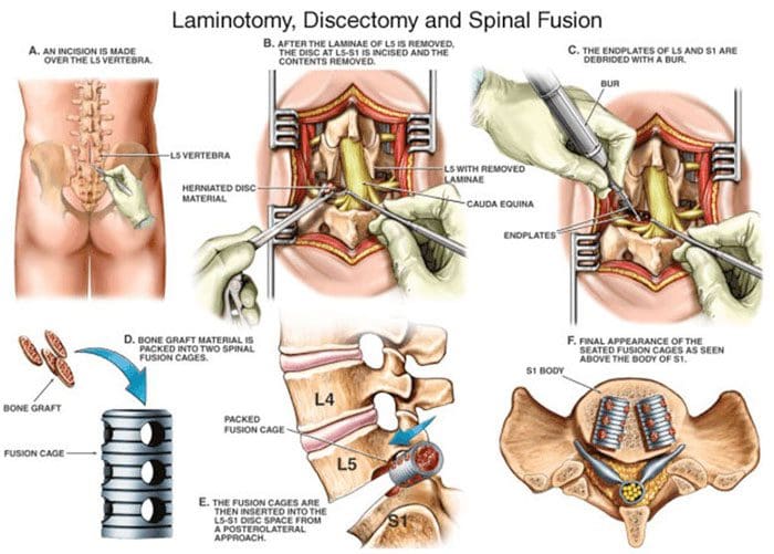 Spinal Surgery Options