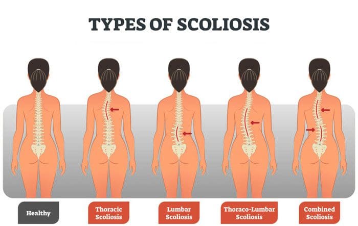 Adult Scoliosis: Diagnosis, Measurements, and Chiropractic