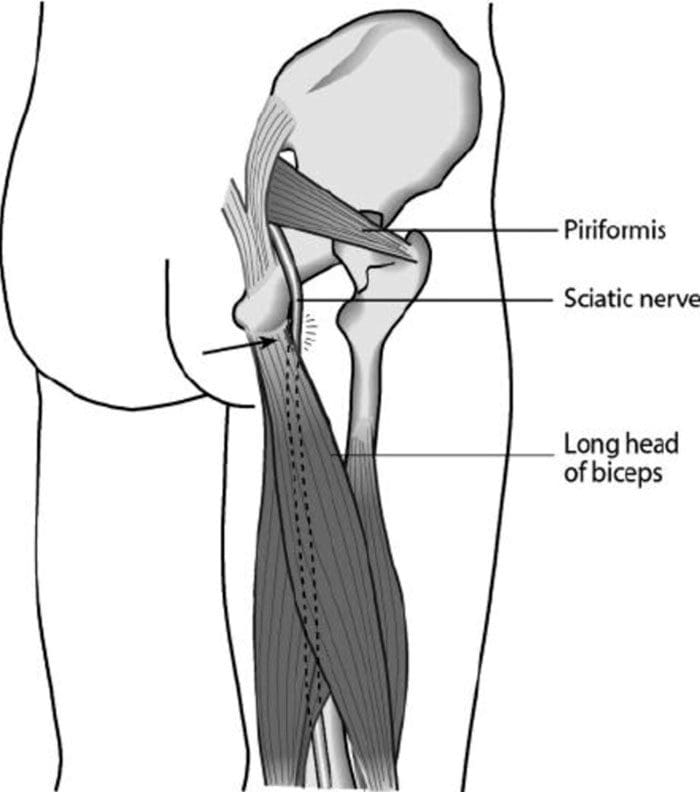 Hamstring Syndrome, Sciatica, and Chiropractic