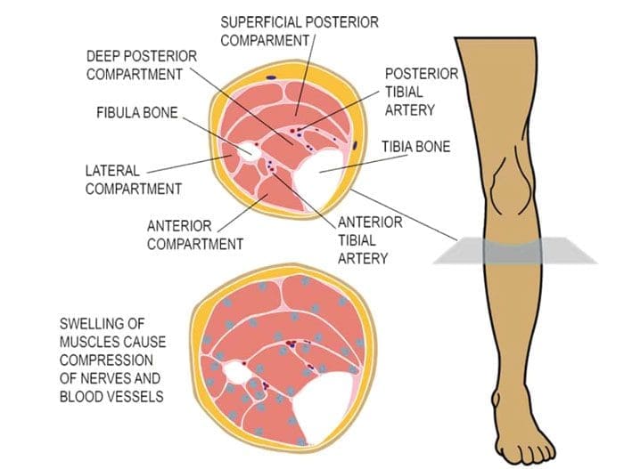 Compartment Syndrome Leg Pain