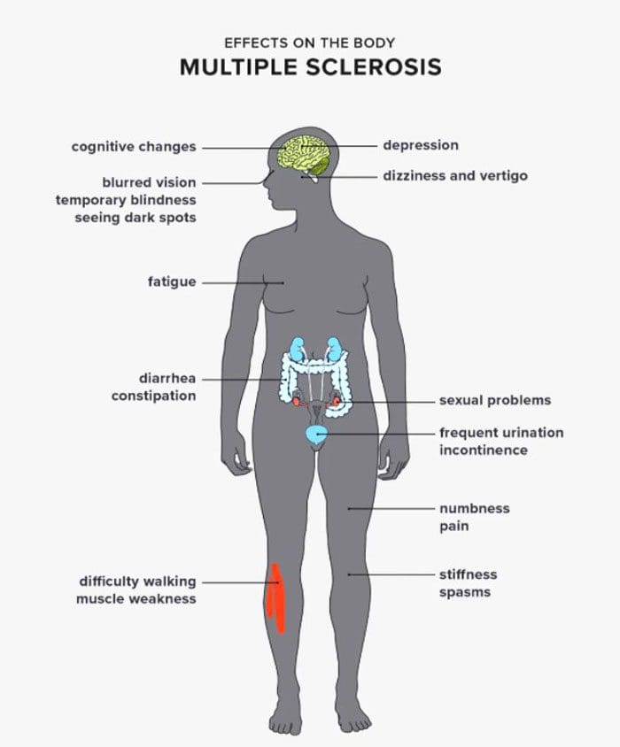 Multiple Sclerosis, Sciatica, and Nerve Pain