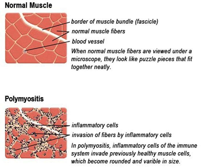 Polymyositis: Inflammatory Myopathy