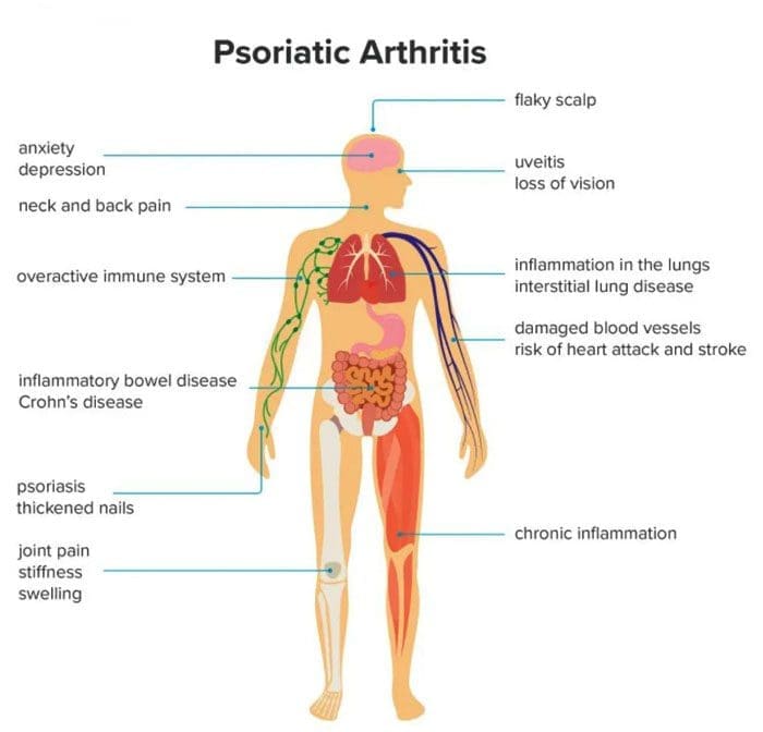 Artritis psoriatica Kniepijn