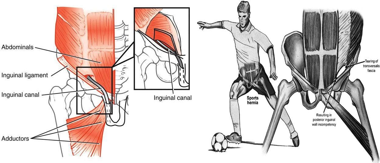 Sports Hernia: Core Muscle Injury