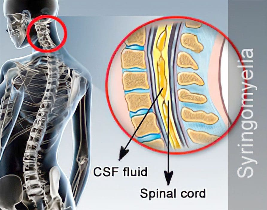 Syringomyelia Spinal Cord Disorder