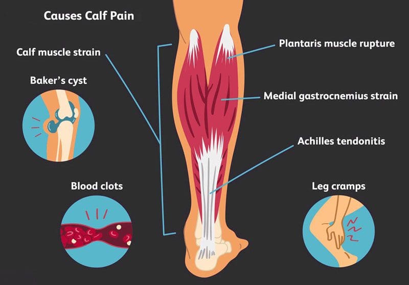 Calf Muscle Tightness and Injury