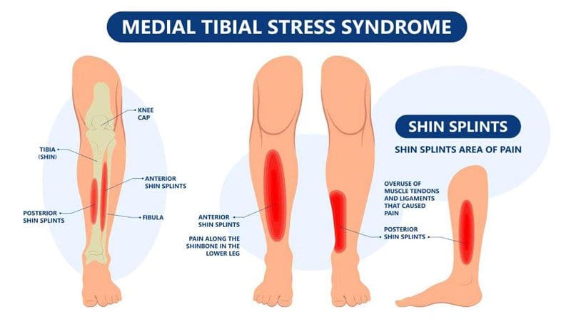 Medial Tibial Stress Syndrome: Shin Splints