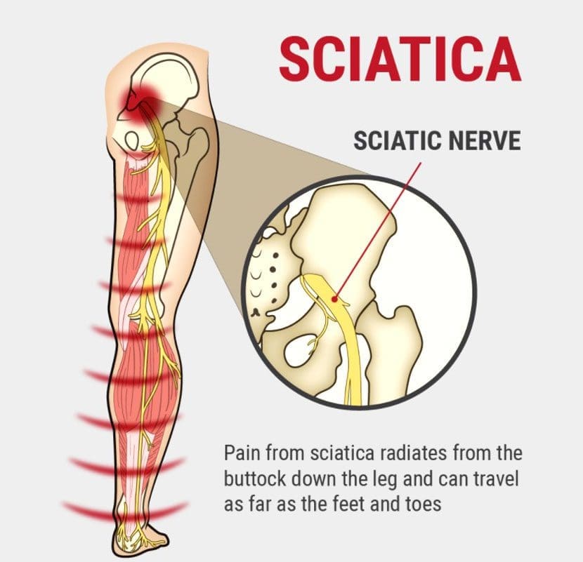 Sciatic Nerve Injury