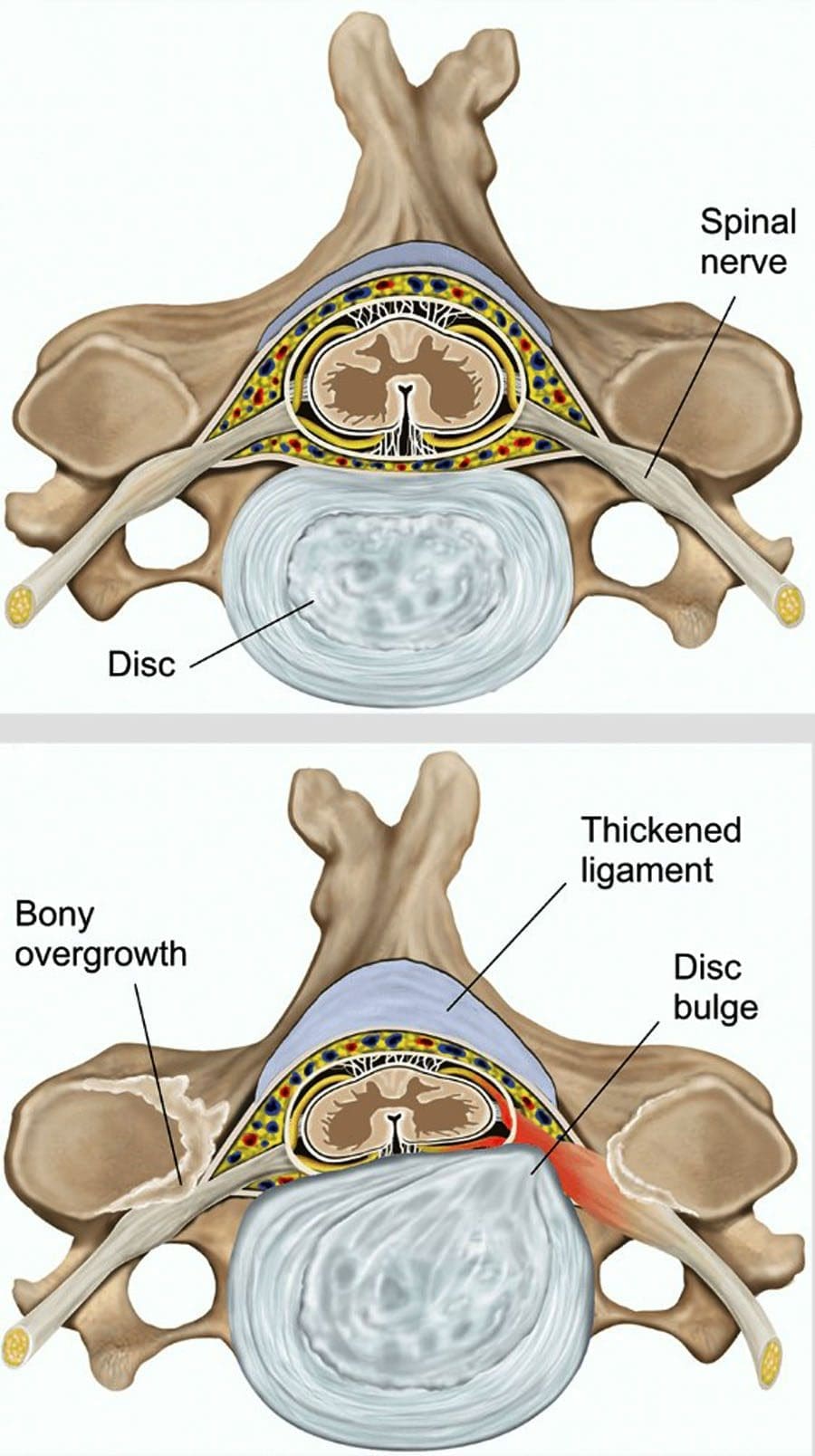 Chiropraktiker Empfehlungen: Zervikal Spinal Stenose