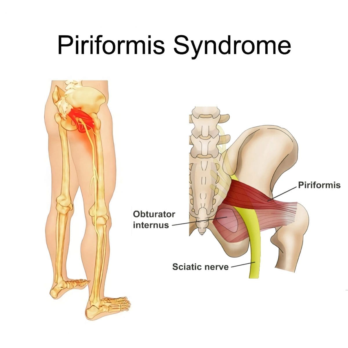 Облекчаване на дълбока болка в седалището: Лечение на синдром на Piriformis