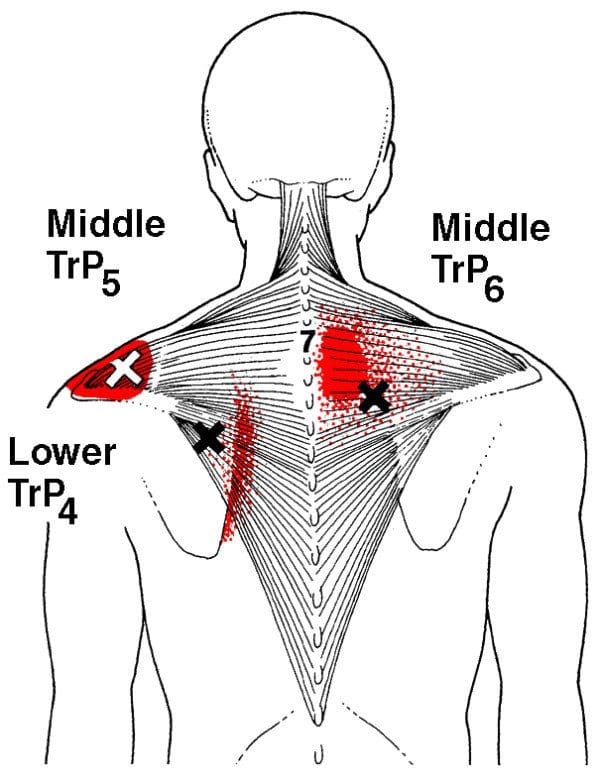 Myofascial Trigger Pain Affecting The Trapezius Muscle El Paso, TX Doctor Of Chiropractic