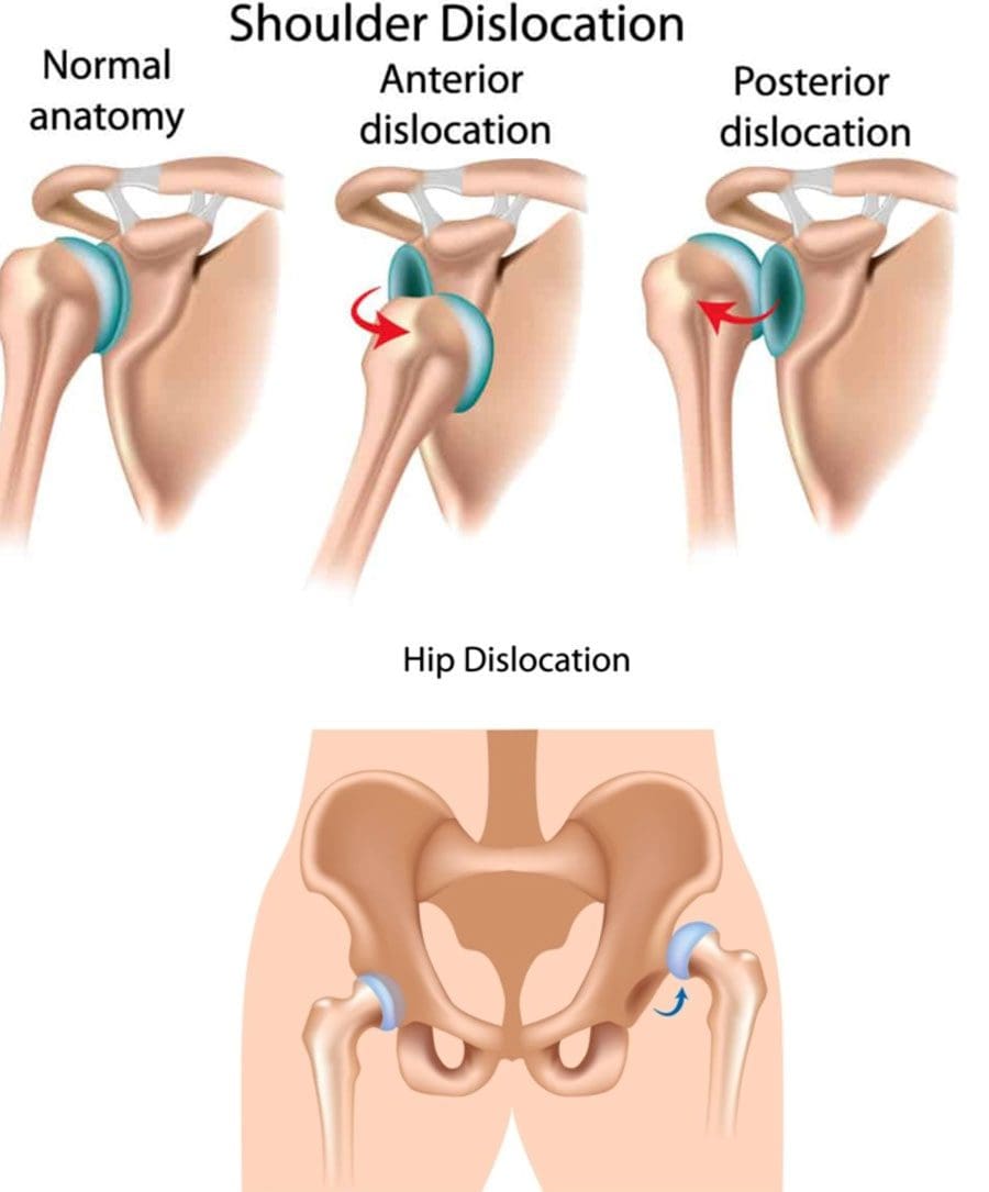 Joint Dislocation Chiropractor 