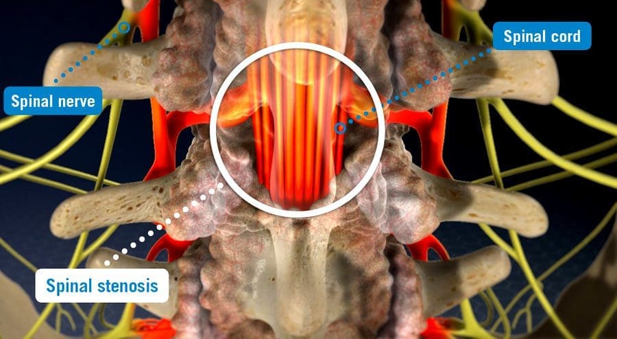 MRI spinalne stenoze: medicinski kiropraktik za poškodbe