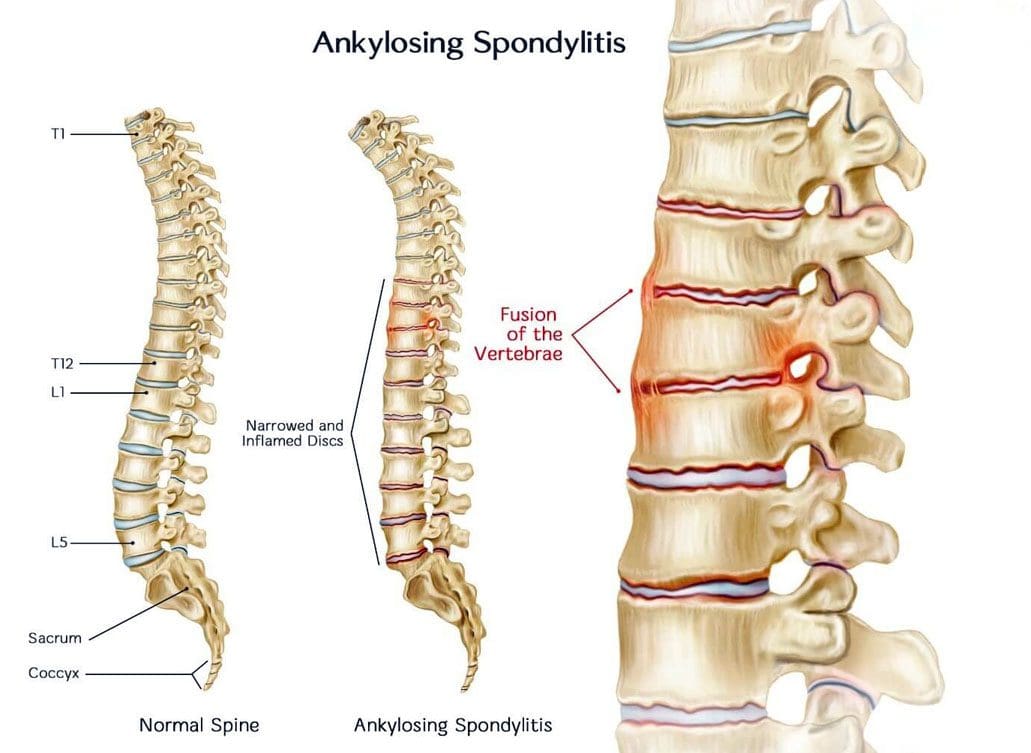 Spondylitis Types