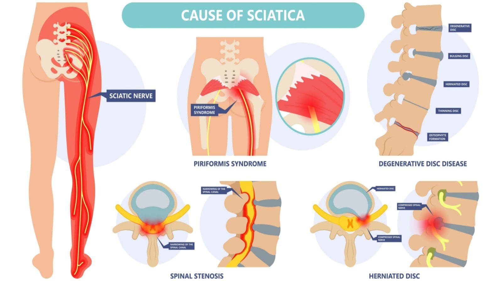 Acute, Chronic, Alternating, and Bilateral Sciatica Chiropractor