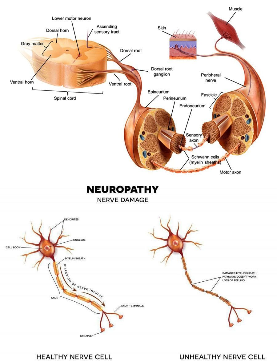 Nerve Damage Symptoms Chiropractor
