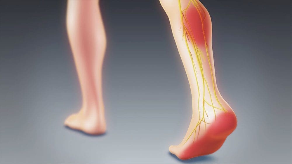Problemas ciáticos no pé e no tornozelo: Quiropraxia médica para lesões