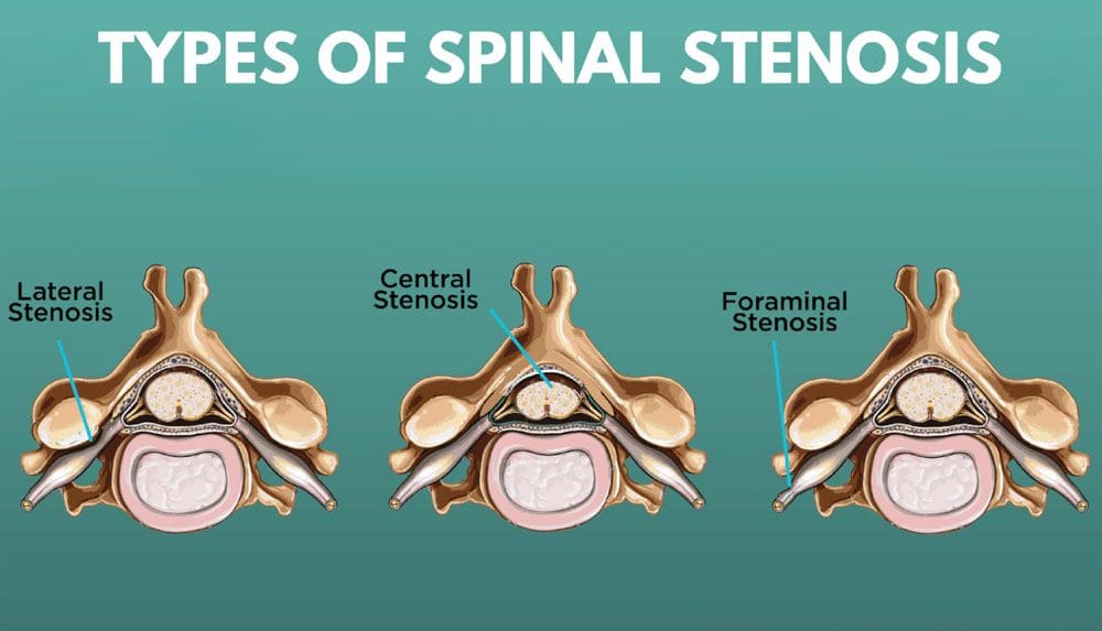 Lateral Recess Stenosis: Injury Medical Chiropractic