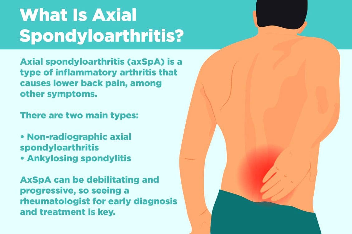 Non-Radiographic Axial Spondyloarthritis: EPs Chiropractic Team